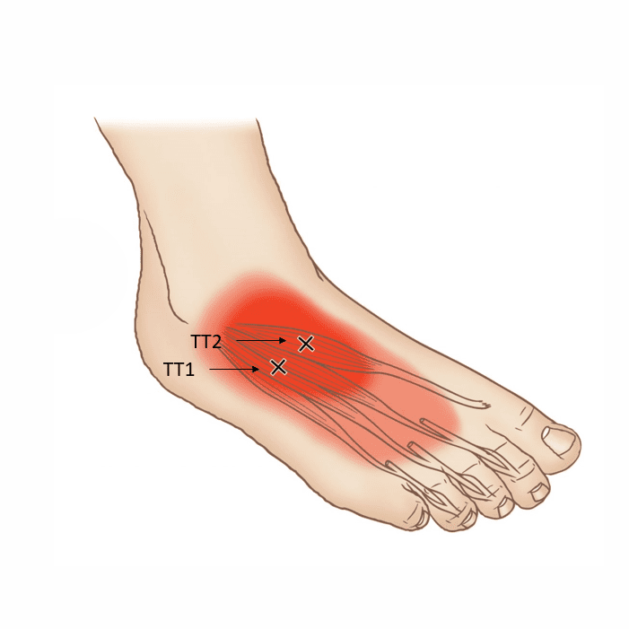 Триггерные точки короткого разгибателя пальцев стопы