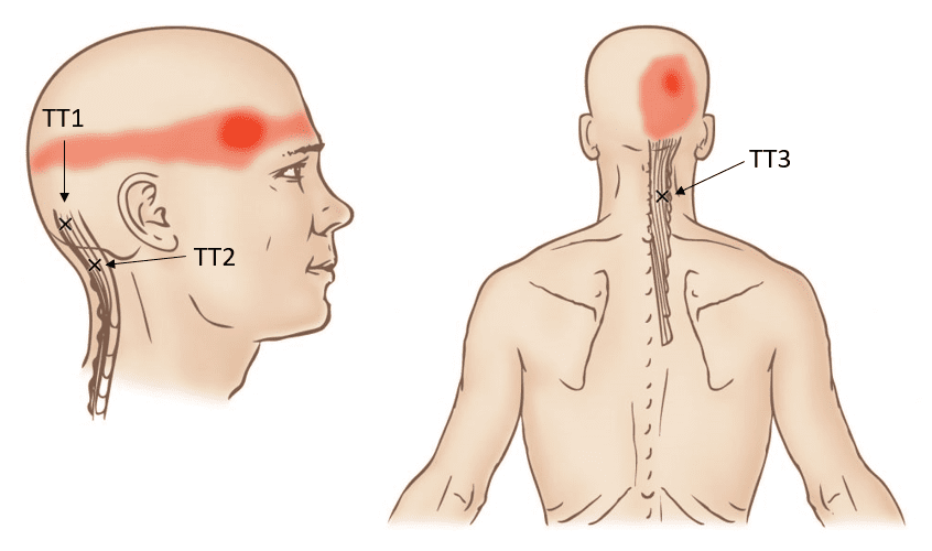 Триггерные точки полуостистых мышц