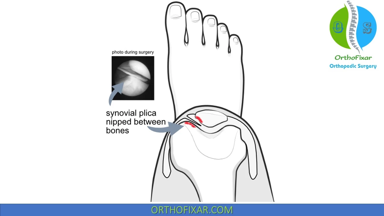Синдром синовиальной складки — Physiotherapist Синдром синовиальной складки