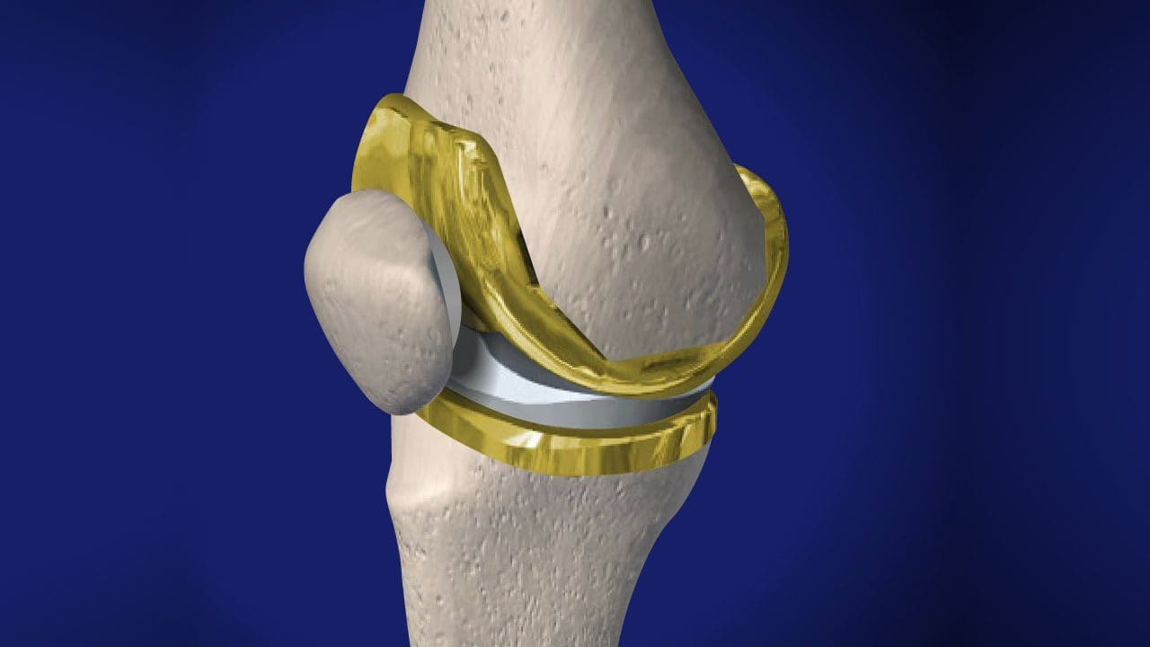 Тотальное эндопротезирование коленного сустава