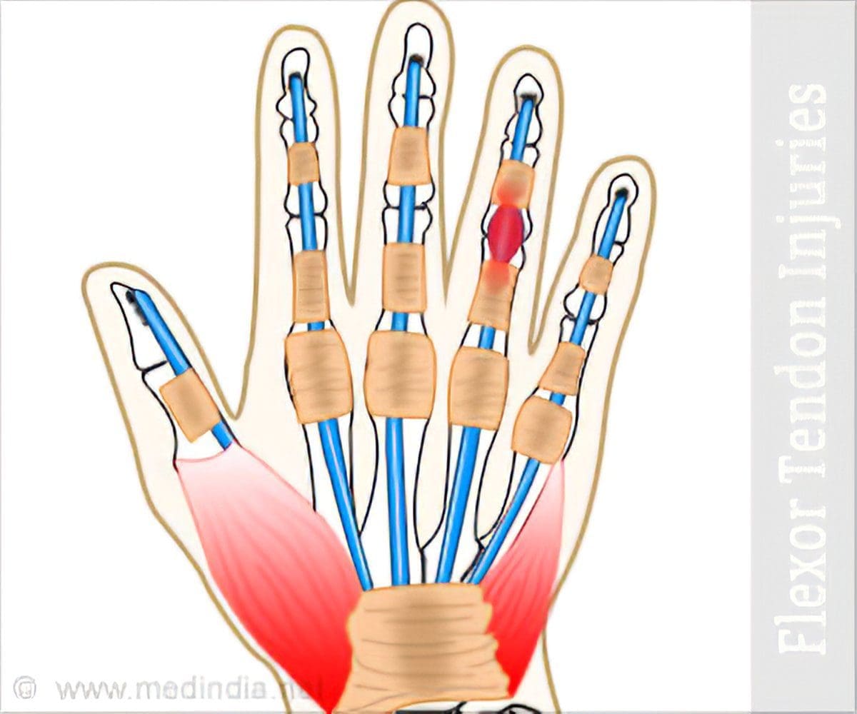 Повреждение сухожилий сгибателей кисти — Physiotherapist Повреждение сухожилий сгибателей кисти