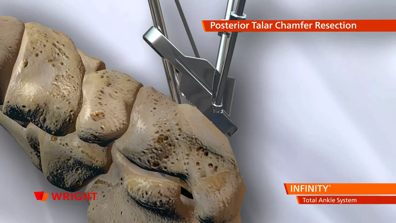 Эндопротезирование голеностопного сустава