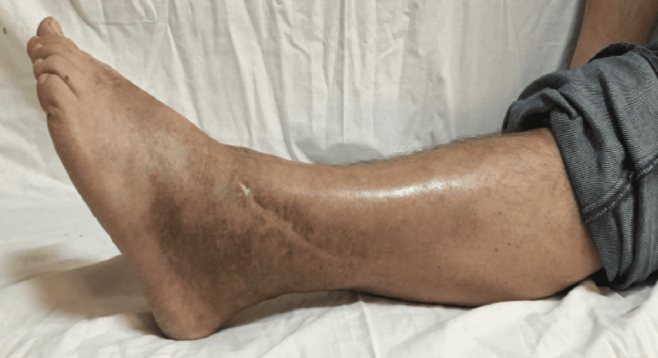 Эндопротезирование голеностопного сустава